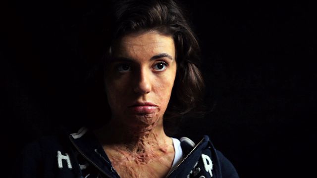 eine junge Frau mit dunklen halblangen Haaren, die Narben im Gesicht und am Hals hat.